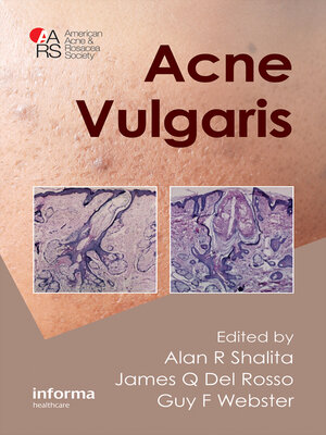 cover image of Acne Vulgaris